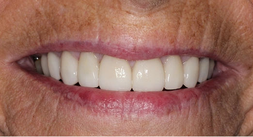 Before and After a Smile