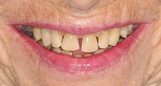 Before and After a Smile